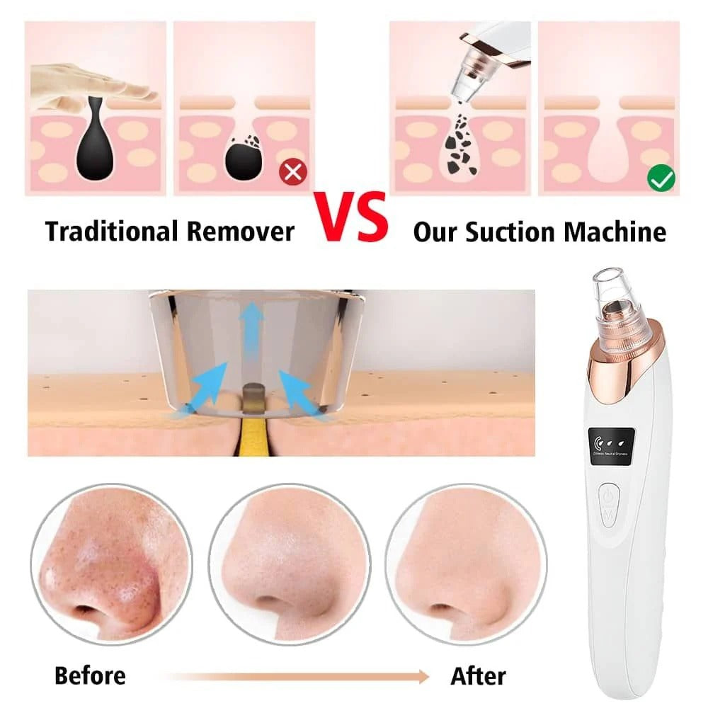 Electric Blackhead Remover – Vacuum Pore Cleaner with 5 Suction Heads